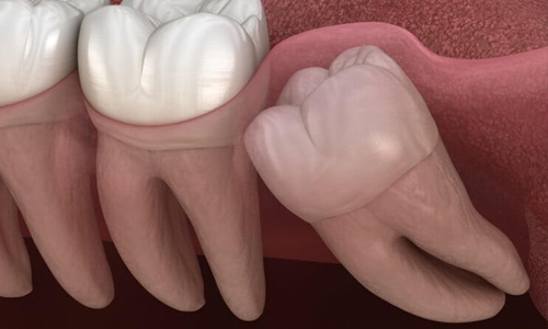 20 Yaş Dişi Çekimi