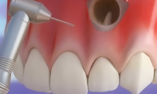 Apikal Rezeksiyon Operasyonu
