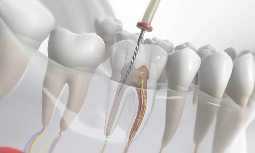 Endodonti (Kanal Tedavisi)