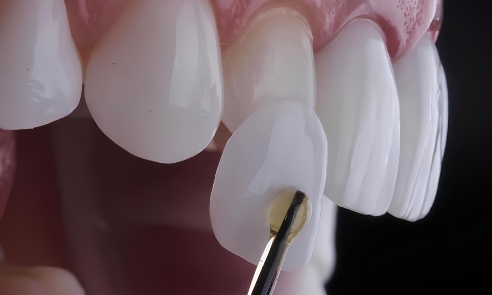 Porselen Lamina (Laminate Veneer)